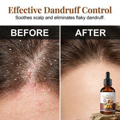 Ginger Anti-Hair Loss Treatment for Hair Growth