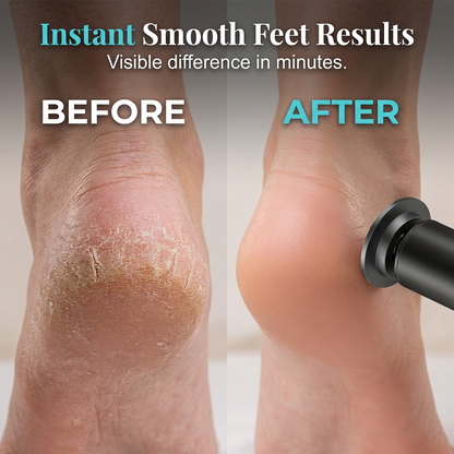 💖 60% OFF TODAY ONLY! 👣 Rechargeable Electric Foot Callus Remover ✨ Instantly Removes Dead Skin & Tough Calluses